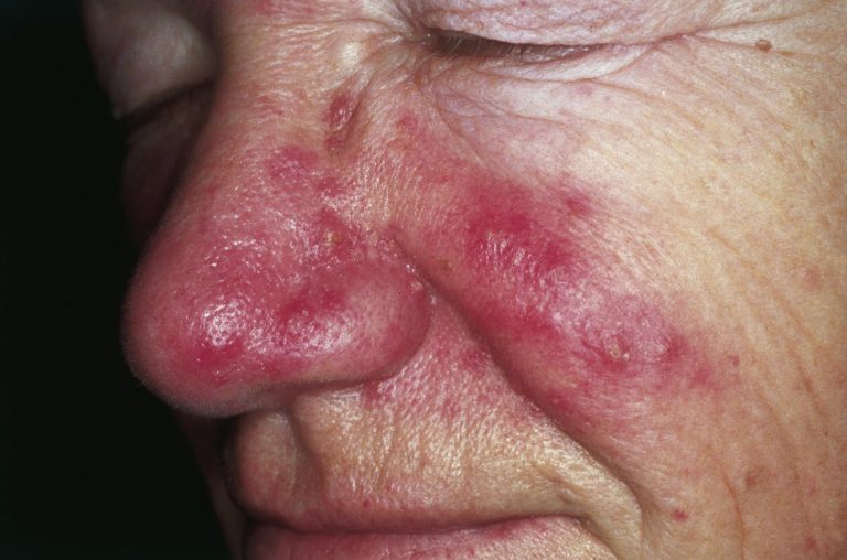 Ayuda natural para rosácea con Fitoterapia China
