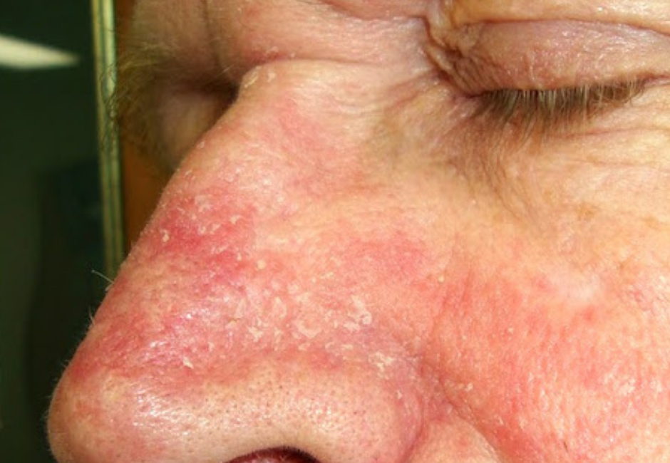 Tiene la Dermatitis seborreica una causa interna? Las respuestas de la MTC  - Erlingen