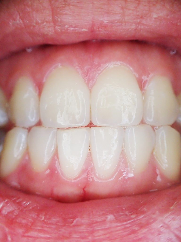 Ayuda para la Gingivitis y la Periodontitis en la MTC